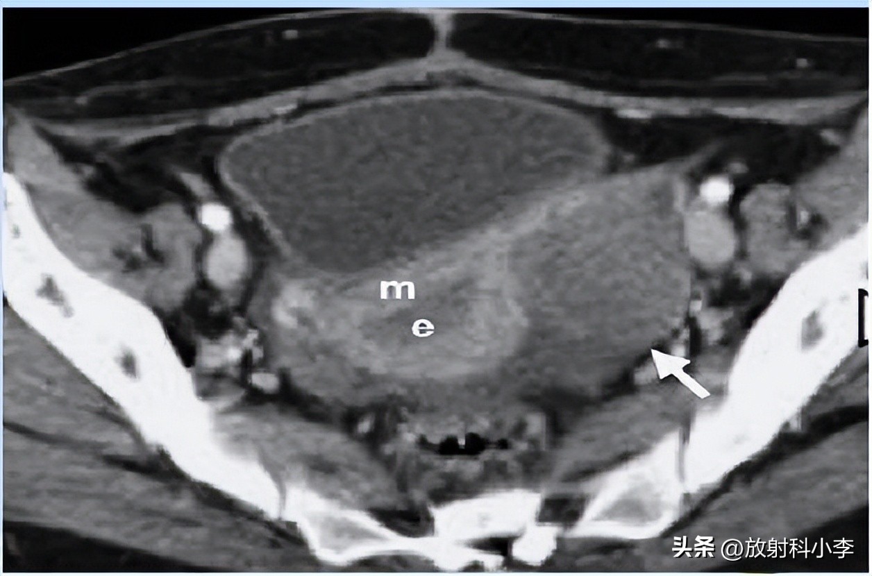 妇科急腹症的ct表现,妇科急腹症的诊断与治疗