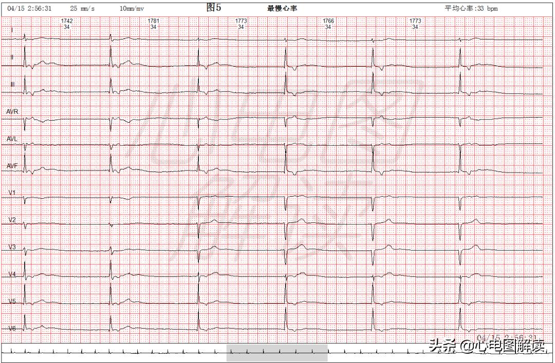 交界性逸搏心律伴窦性心动过缓,交界性逸搏是交界性心动过速吗