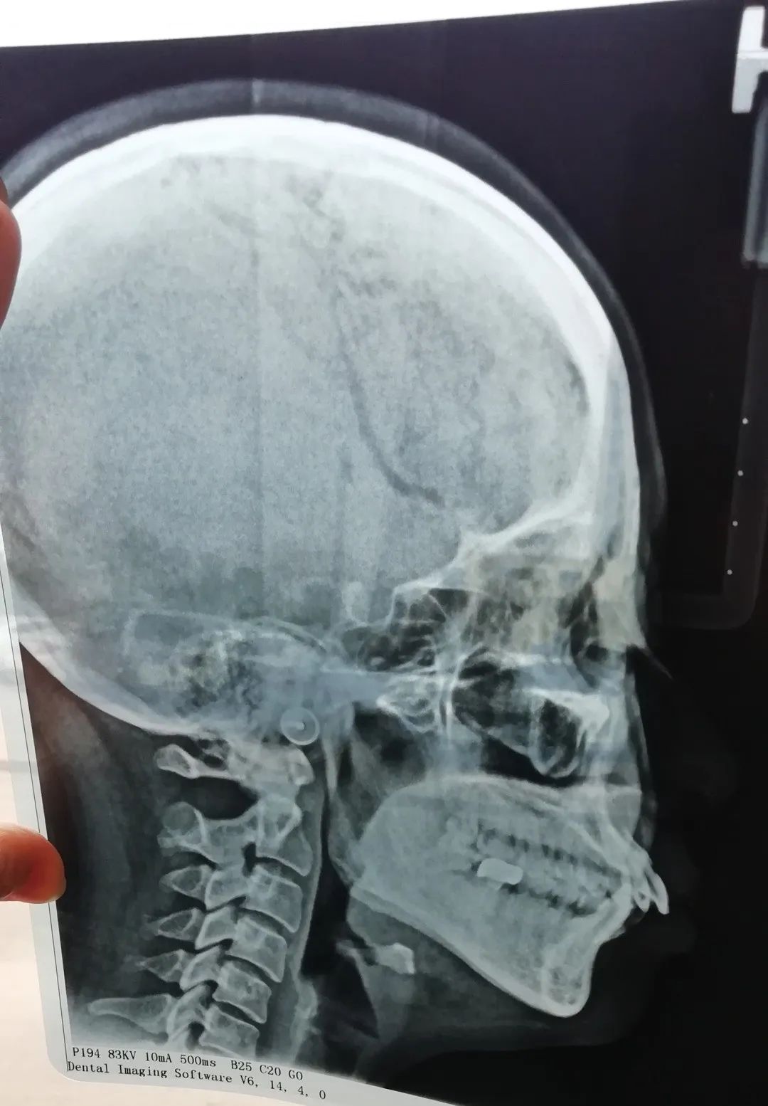 整牙亲身经历分享一下,整牙的经历分享