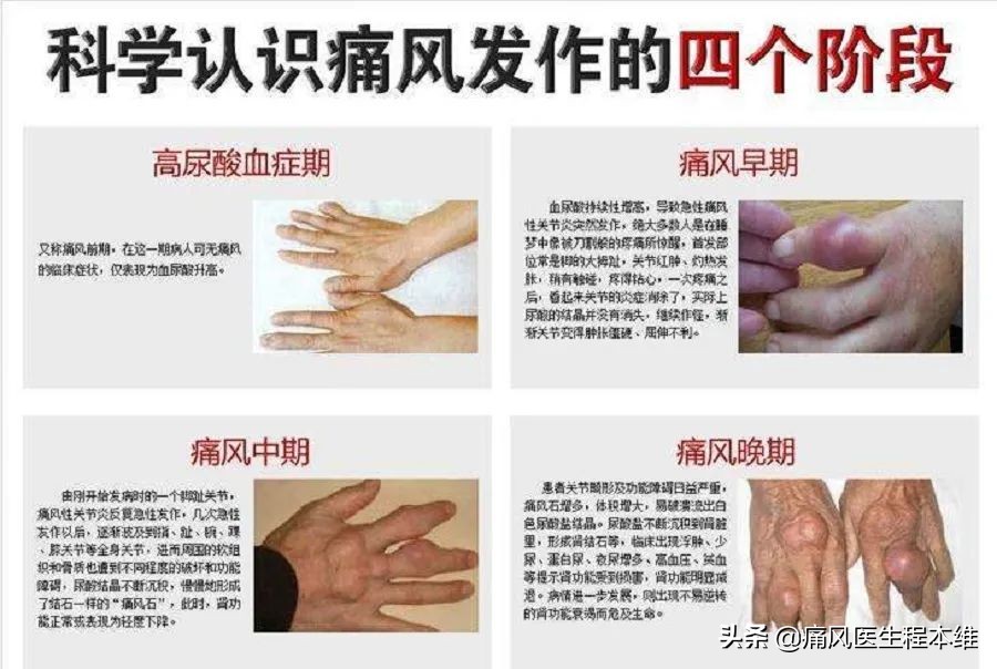 痛风真的没有什么药能根治吗,痛风有没有治好不复发的