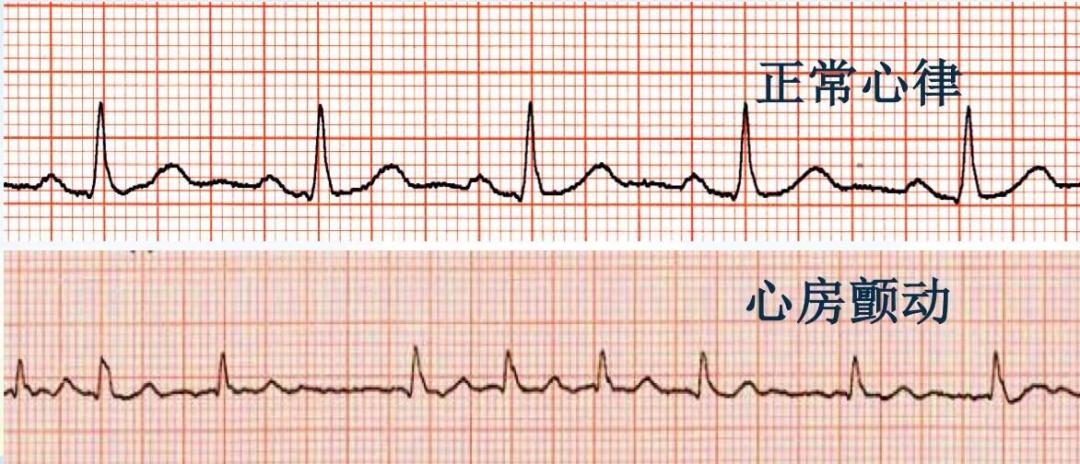 心跳加快不是心动是有病,心跳比较快是心脏病吗