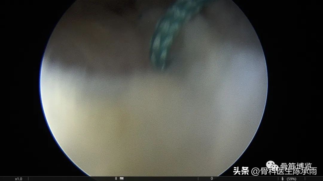 内侧半月板前角囊肿,关节镜下内侧半月板部分切除术