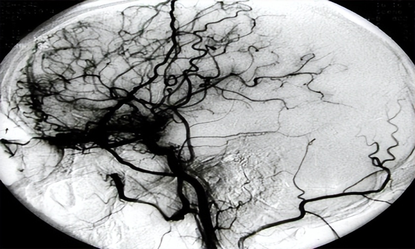 检查烟雾病脑子里有异常信号,左侧大脑烟雾病