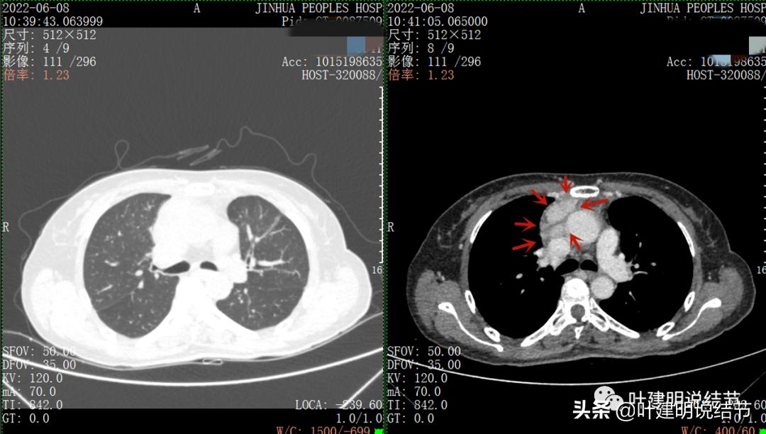 这位老乡，乏力来查，查出这么大个的纵隔肿瘤！会是什么呢？