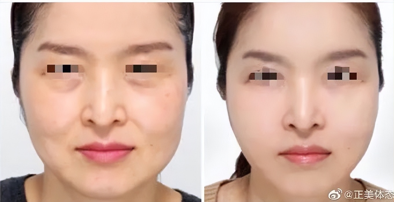 精致小脸的10个方法,精致脸如何变美