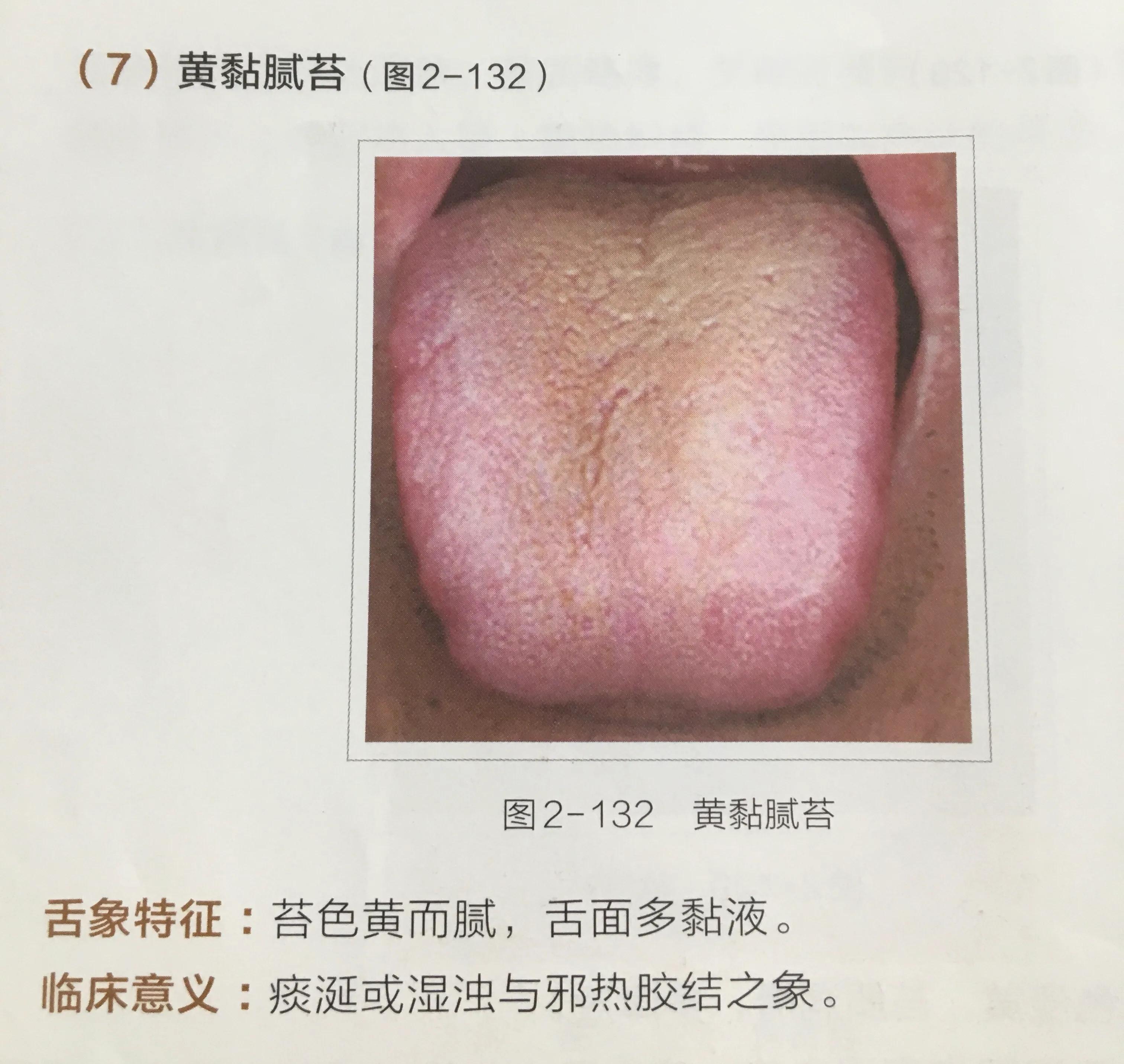 苔白舌诊与疾病对照图,舌诊中舌质红且有苔