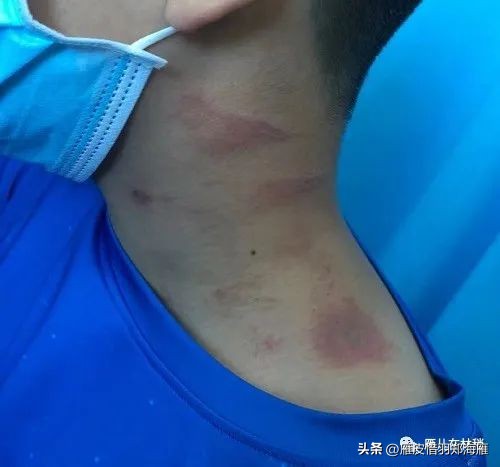 九月初预警：隐翅虫年度盛典，奇怪皮炎频现，教您如何躲着点