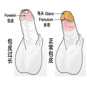 25岁包皮过长有必要手术吗,成年人包皮过长的患者多不多