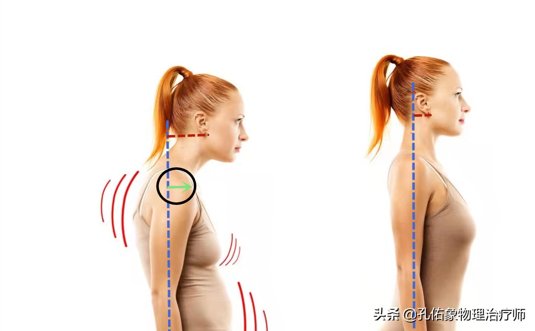颈椎肩周炎肩胛骨疼痛怎么锻炼,锻炼造成肩胛骨疼痛怎样处理