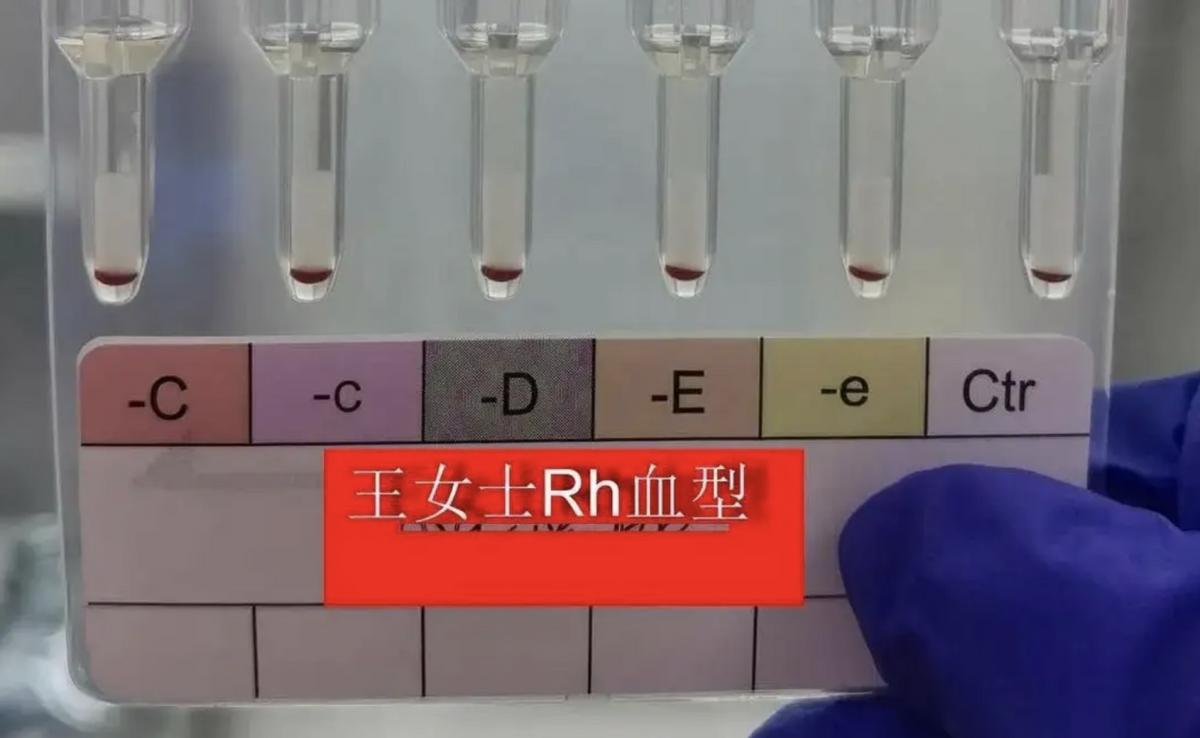 比“熊猫血”还稀有的救命血,世界上最罕见的血熊猫血