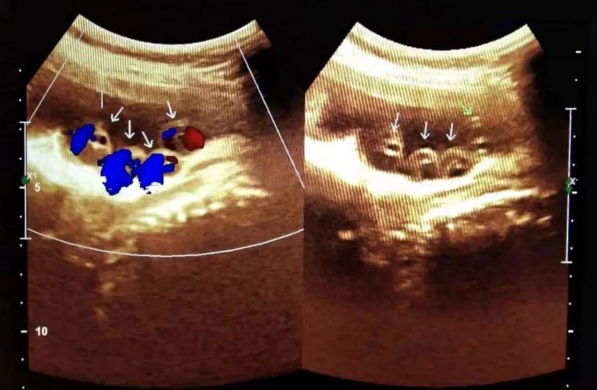 脐带绕颈一周纠正胎位的最佳方法,34周脐带绕颈一周能自己绕开吗