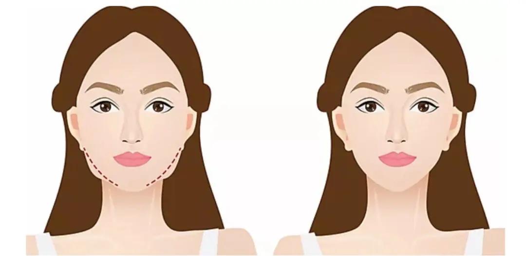 注射瘦脸针消除咬肌,打完瘦脸针会面部凹陷吗