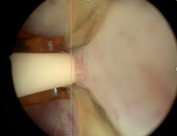 前列腺增生水蒸气消融术的弊端,水蒸气消融术治前列腺增生怎么做