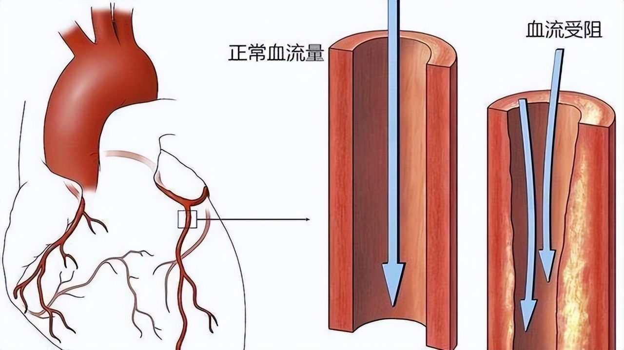 动脉粥样硬化斑块不用吃药,动脉夹层不需要放支架的微创