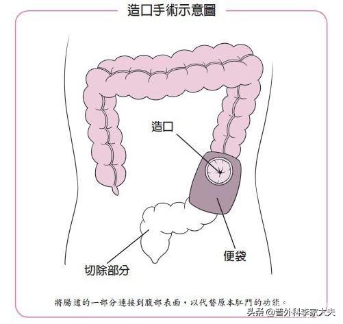 严重的直肠癌术后吻合口漏，该如何治疗？