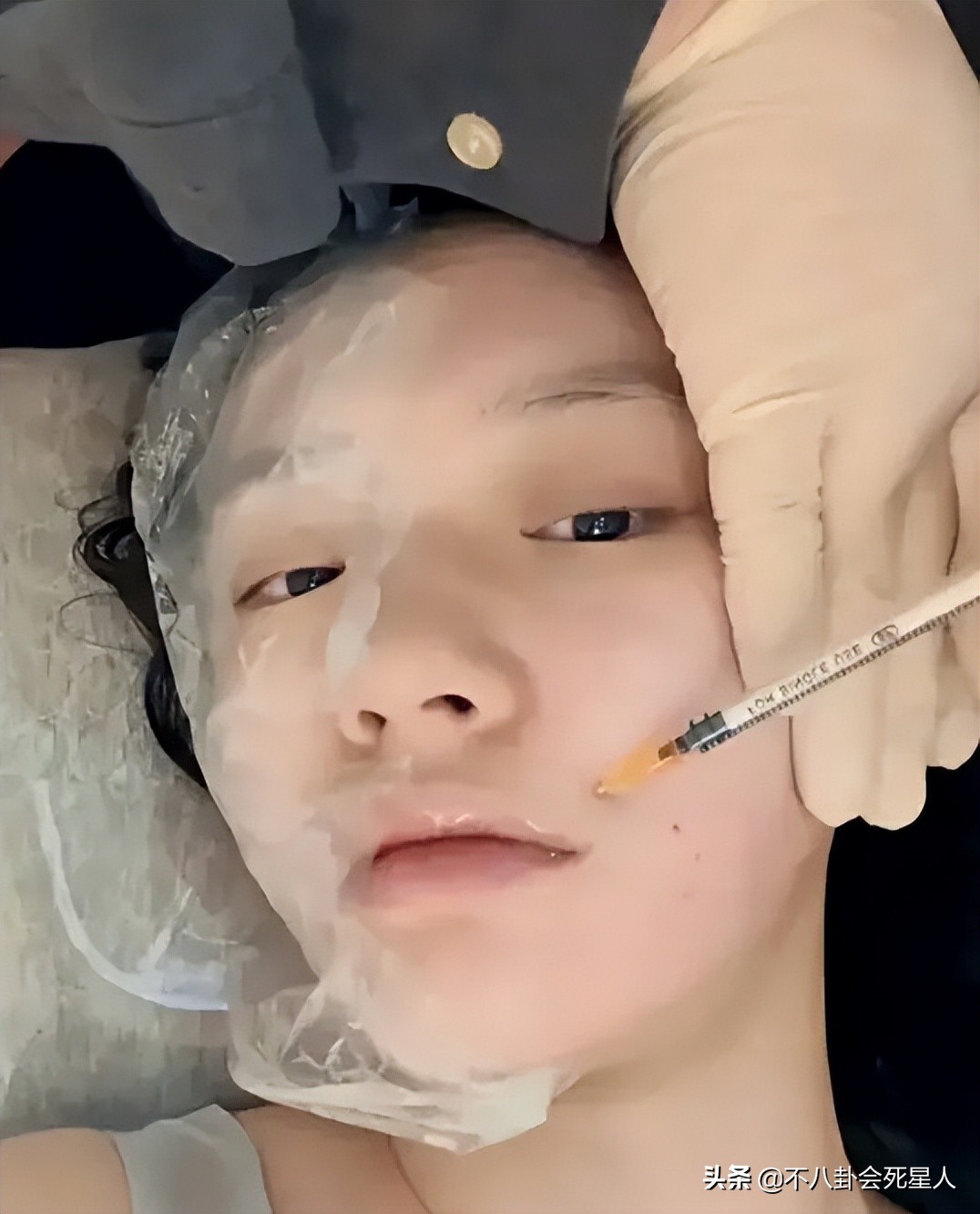 景甜双眼皮调整前后,明星自曝医美