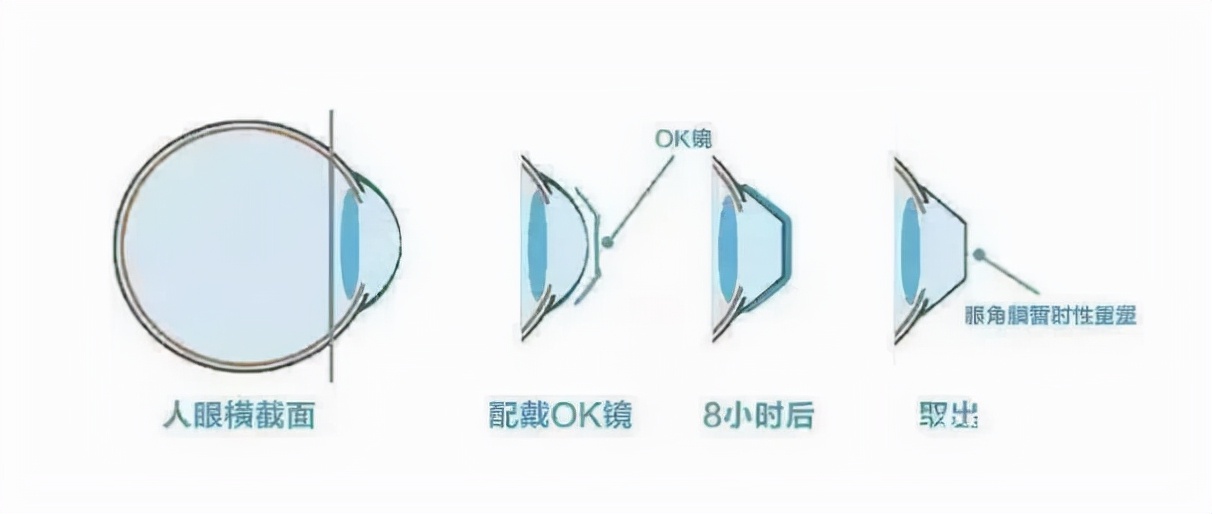 两分钟的预防近视眼的方法,治疗近视眼秘诀