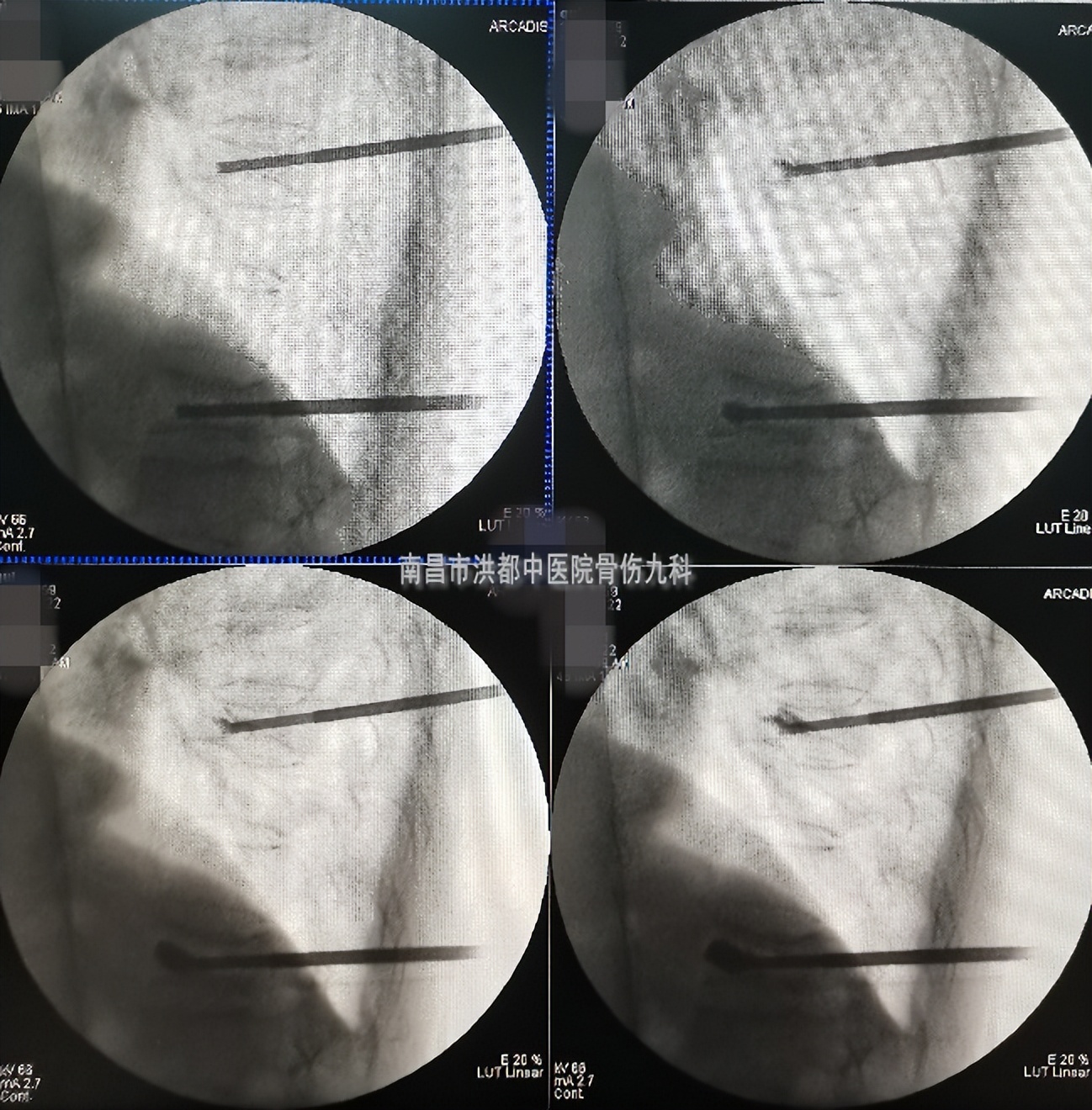 打个喷嚏导致腰椎骨折视频,打个喷嚏全身骨折视频