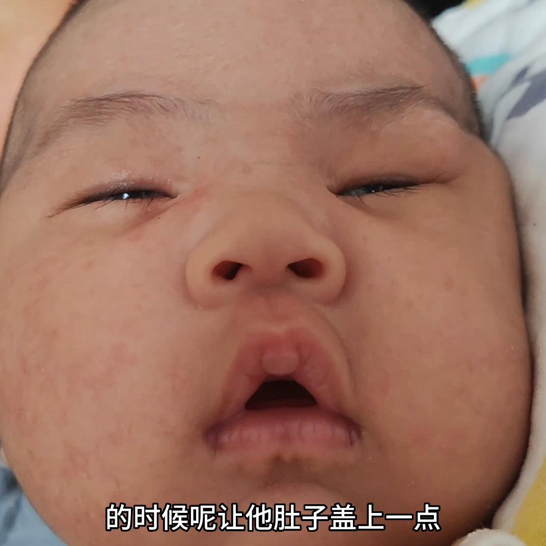 小宝宝长湿疹的最佳治疗方法,婴儿出生十天长湿疹怎么办