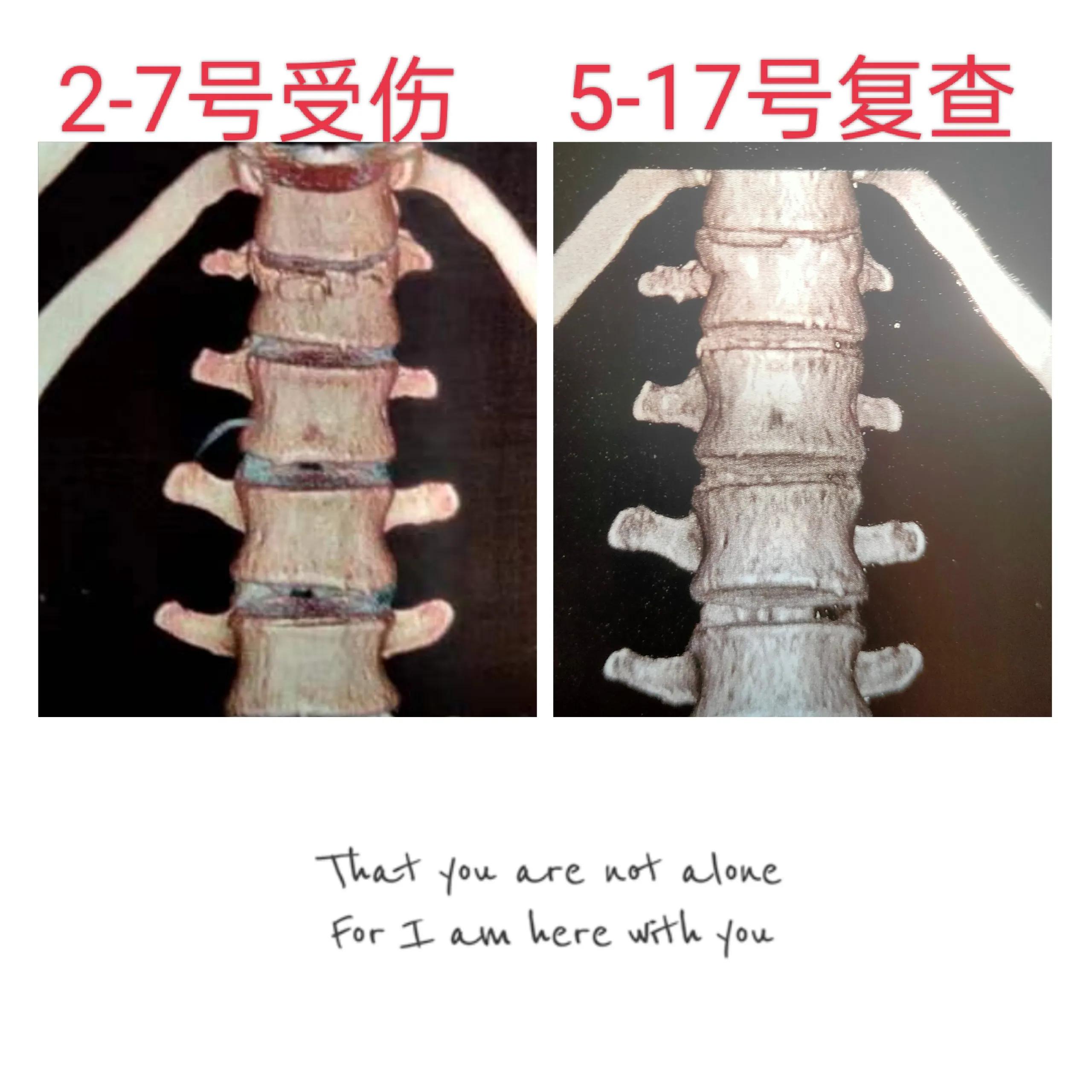 胸12椎体压缩性骨折复查怎样检查,腰2椎体轻度压缩性骨折复查改变