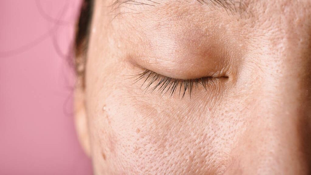 长痘导致肤色大面积色沉,长痘黑色素沉淀的原因