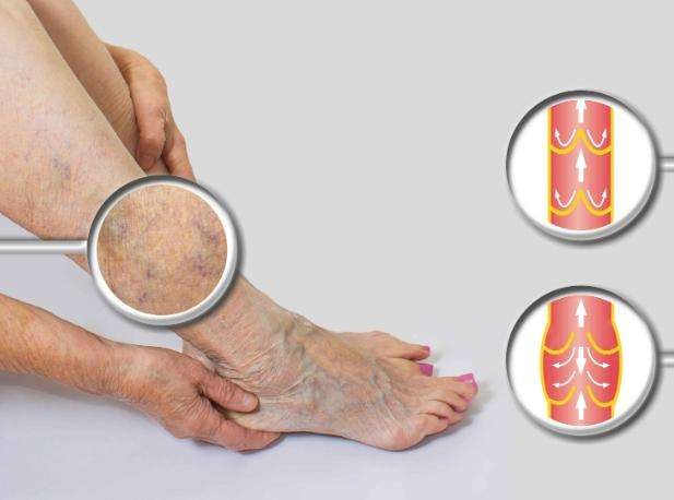 缓解静脉曲张简单实用不花冤枉钱,精索静脉曲张吃药能缓解疼痛吗