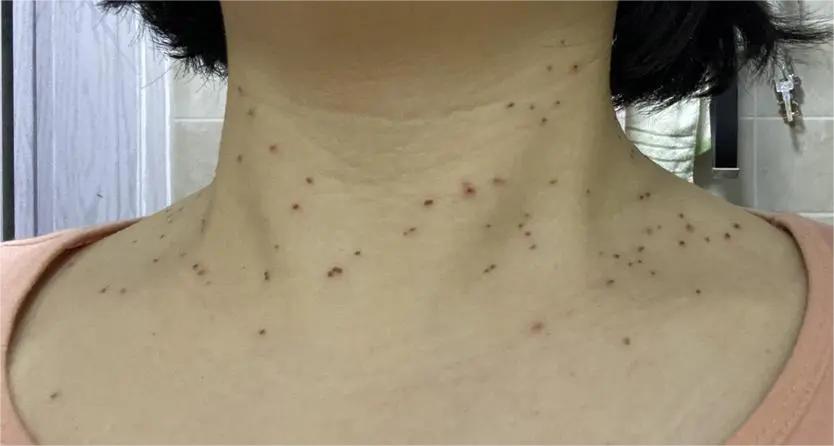 脖子上长了很多丝状疣怎么去除,脖子上长的小疙瘩丝状疣怎么治