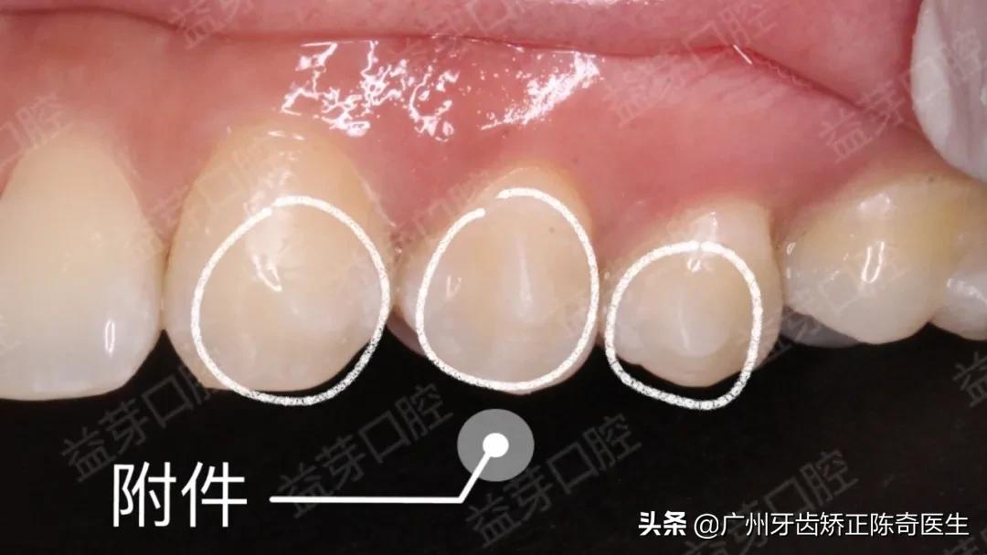 附着在牙齿上面硬硬的东西是什么,牙齿连接处有小疙瘩