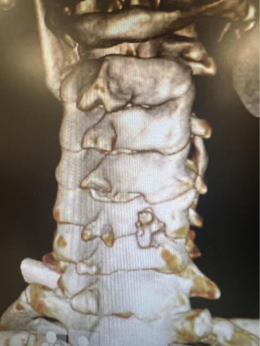 西安椎间孔镜手术治疗颈椎,西安红会医院微创