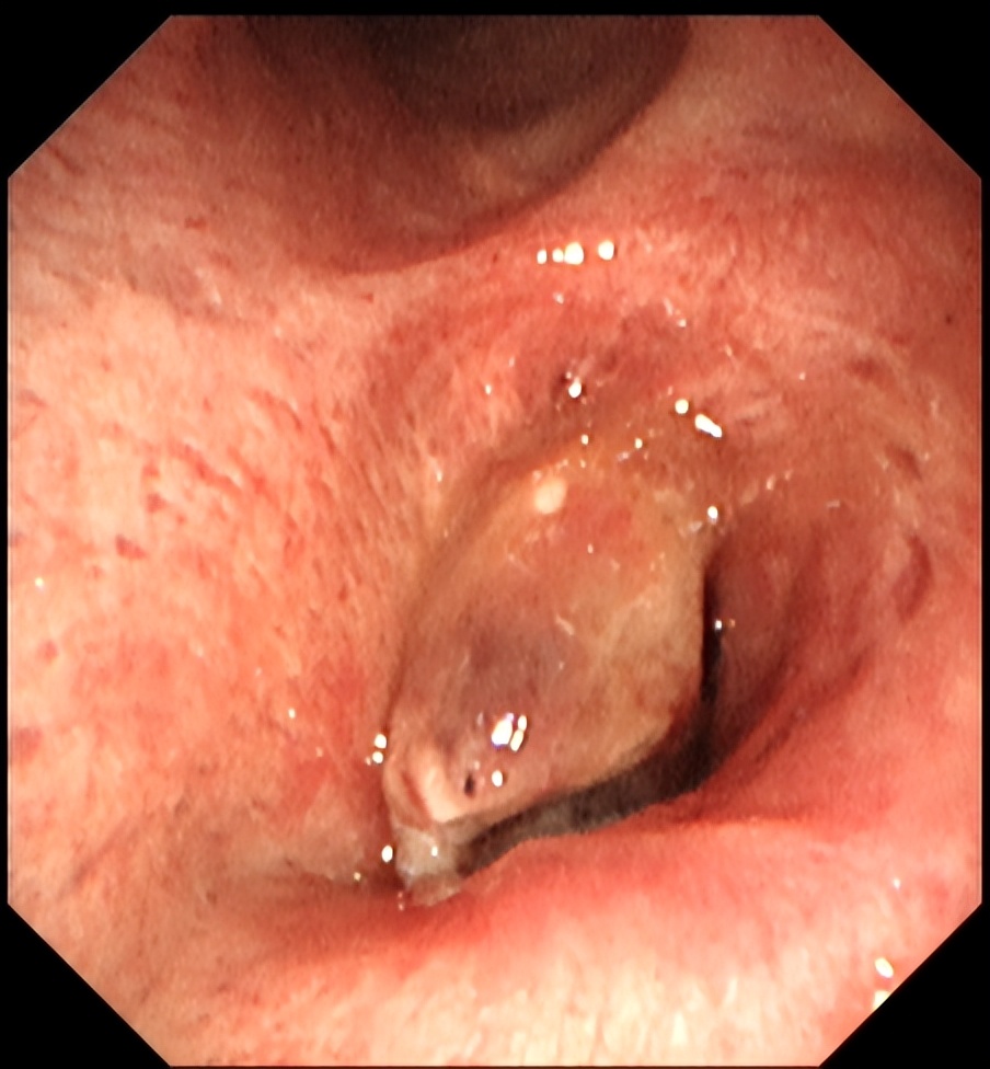 太原市中心医院呼吸介入团队成功开展经气管镜肿瘤微波消融治疗术