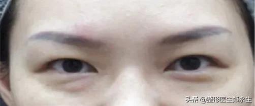 眼袋手术失败再次修复完交费吗,修复失败眼袋手术效果好吗