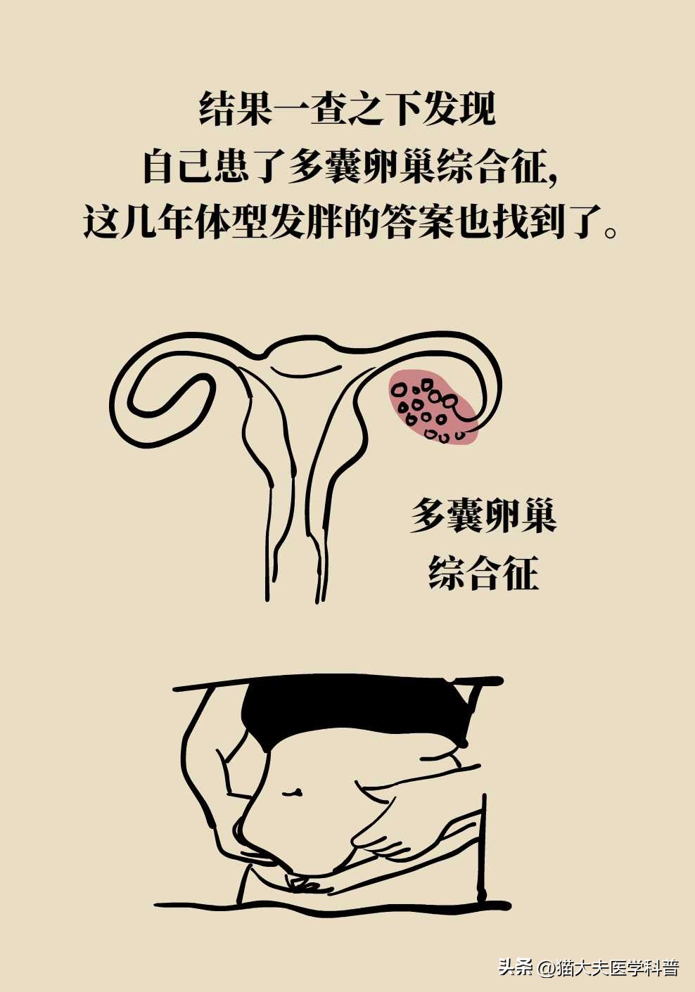 如果不要孩子多囊卵巢需要治疗吗,多囊卵巢综合征有必要治吗