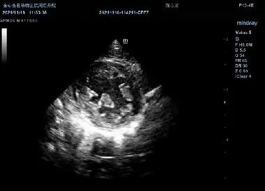 二尖瓣发育不良病例总结