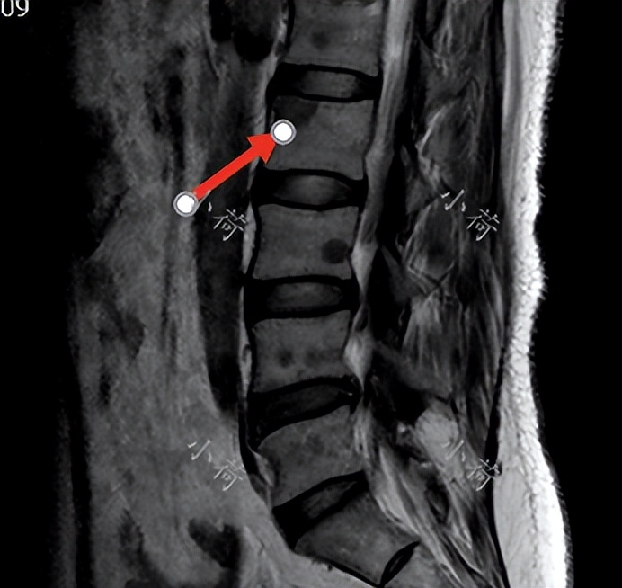 晚期乳腺癌肺转移治愈案例励志,乳腺癌晚期骨转移瘫痪还能活多久