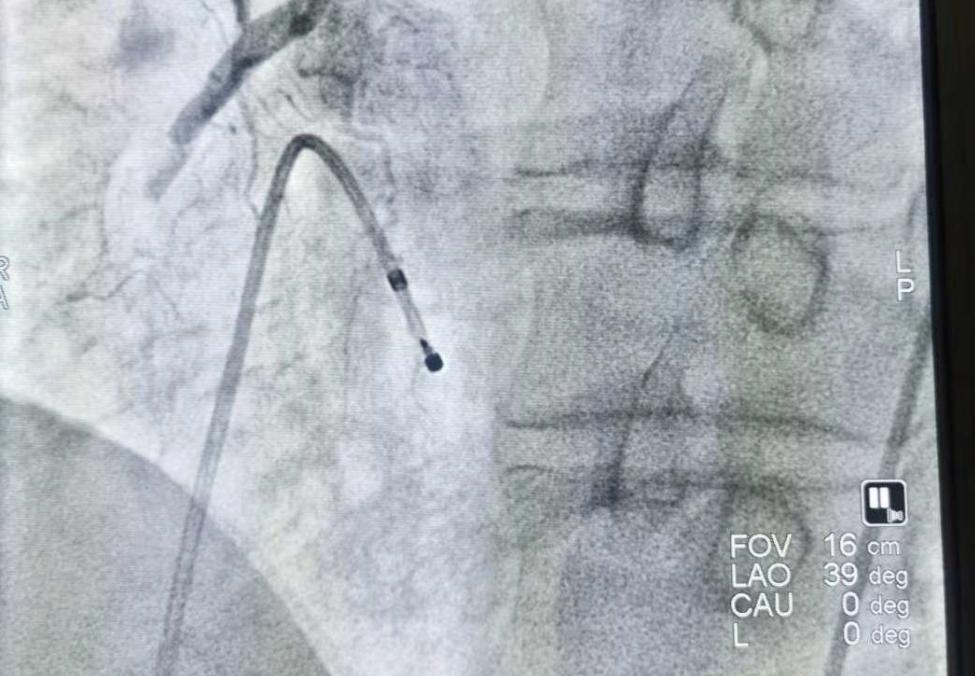 55岁男子酒后胸痛，以为是喝醉了，医生：幸亏我坚持，酒精不背锅