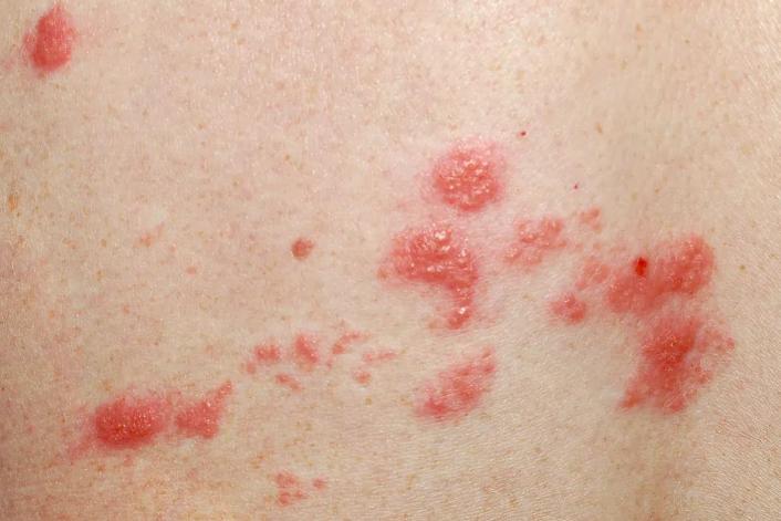 老人得过疱疹后总感冒,老年人得了疱疹多久可以自愈