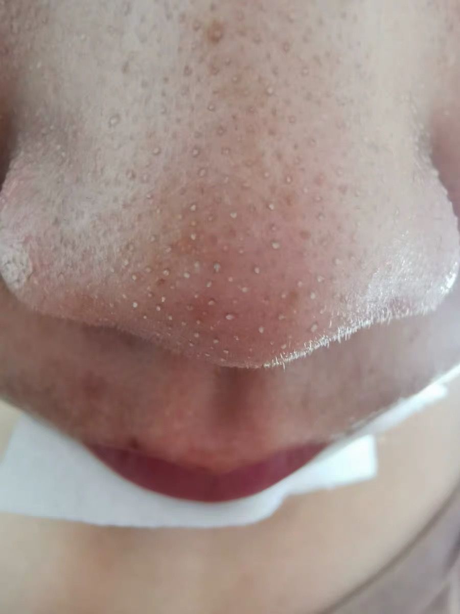 为什么鼻子可以挤出很大的黑头,用夹子挤出鼻子黑头