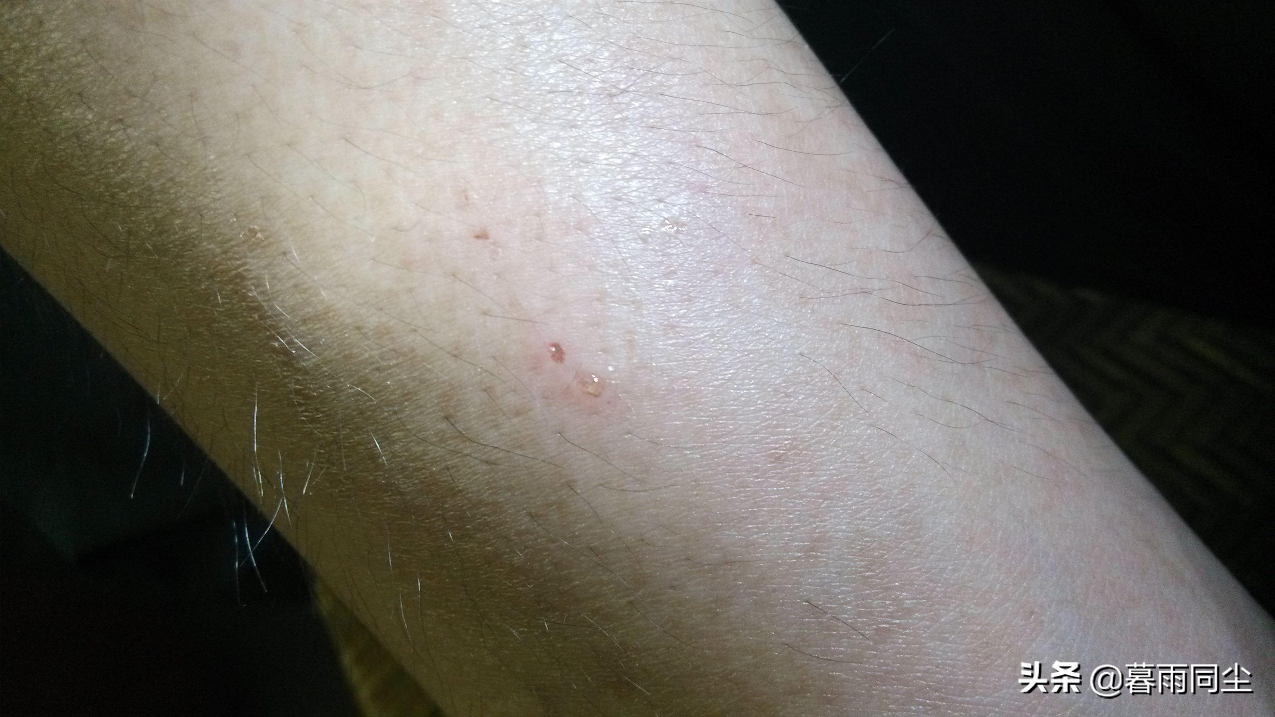 野外旅游怎么防蛇咬伤别人,野外防被蛇咬带什么药可保命