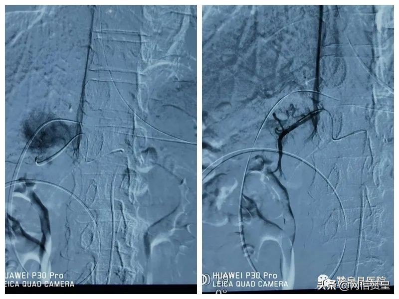 胃窦癌微创切除手术,胃窦癌介入栓塞