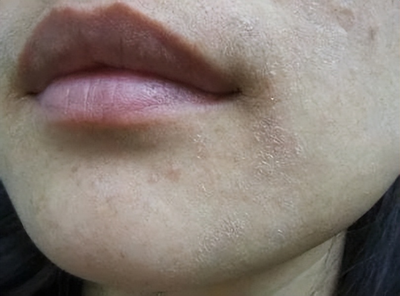 男生脸上很多处脱皮怎么办,男生脸上脱皮干燥