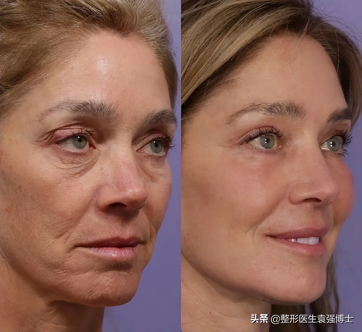 40岁后面部抗衰，填充、光电、线雕、拉皮哪个更靠谱？,医生总结