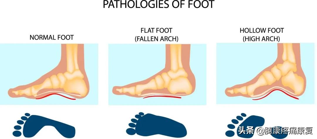 功能性高足弓的练习方式,足弓疼痛3个动作缓解