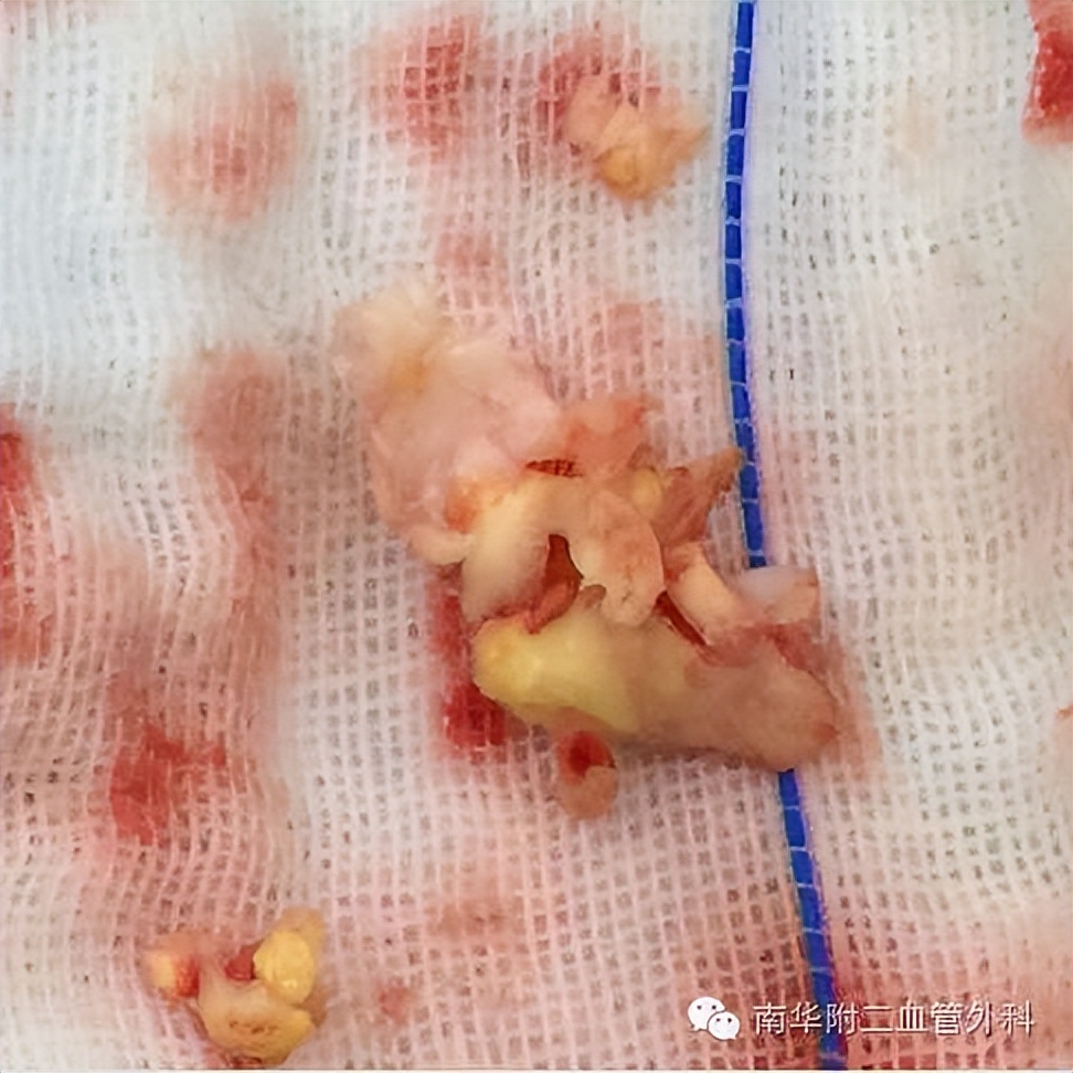 警惕脑卒中隐形杀手颈动脉狭窄,颈动脉闭塞疏通