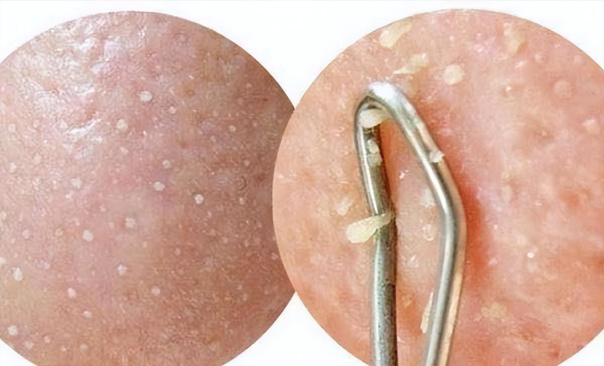 鼻子黑头感觉脏脏的,草莓黑头怎么去除最有效