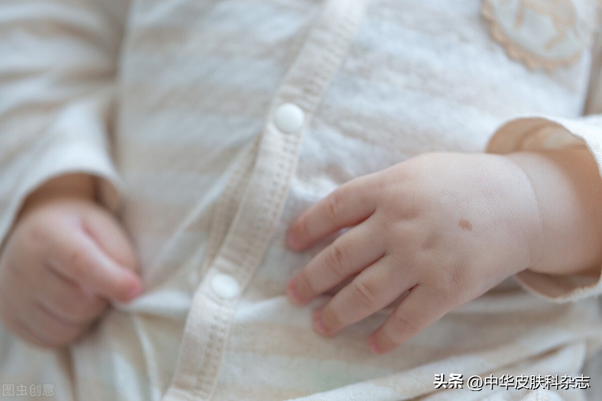 孩子身上有咖啡斑和白斑,儿童身上咖啡色斑