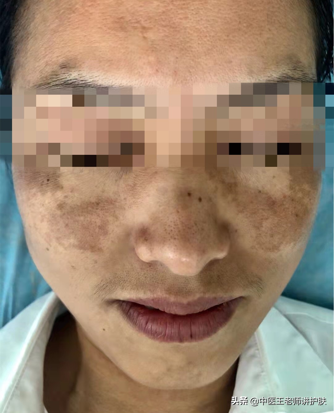 疏肝化瘀调理是治标还是治本,补气血疏肝理气能淡黄褐斑吗