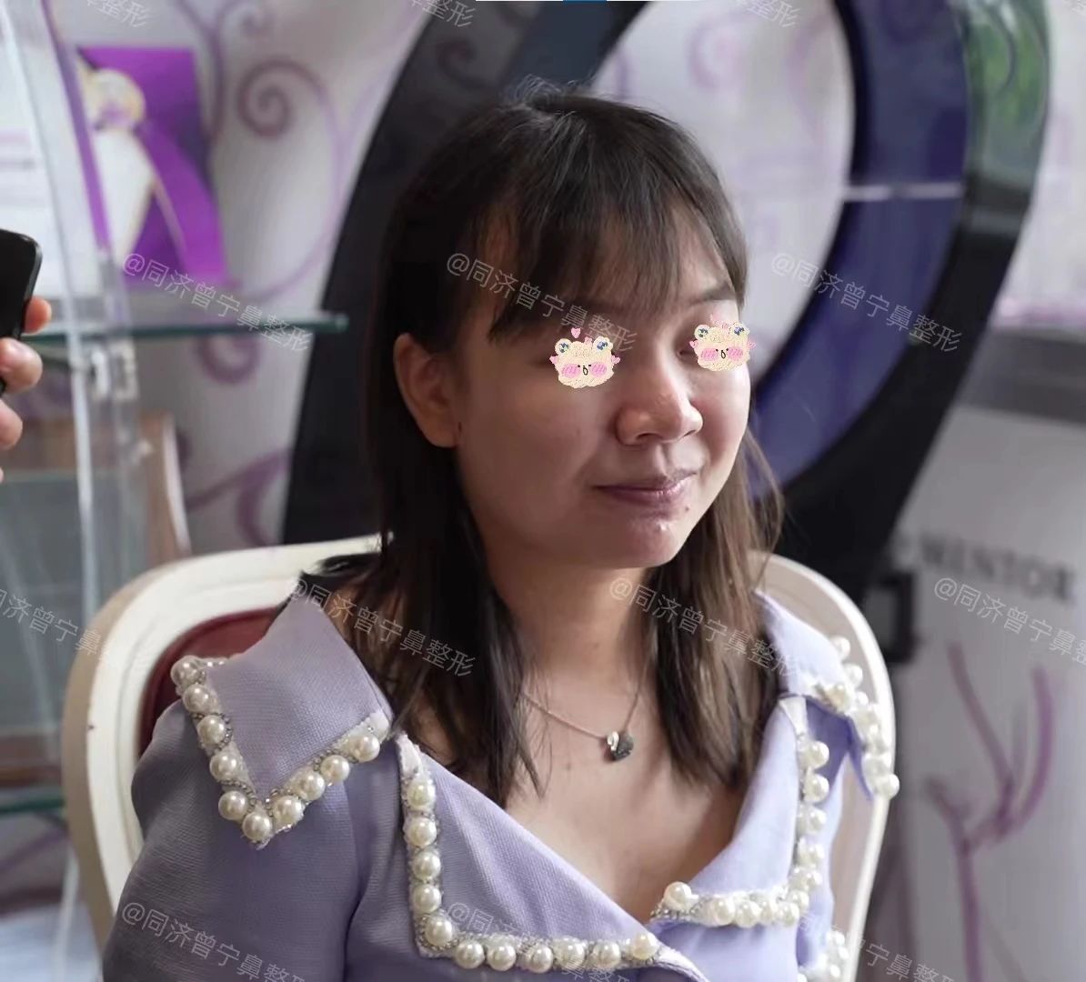 蒜头鼻鼻头大怎么改善,鼻头肉怎么改善鼻型