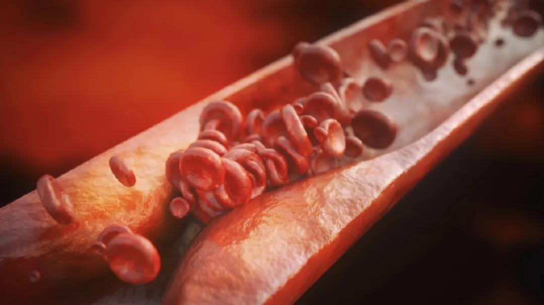 冠心病支架手术后肺会不好吗,冠心病做完支架后支架会移动吗