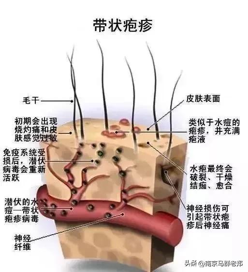 李立群疱疹,李立群治疗疱疹