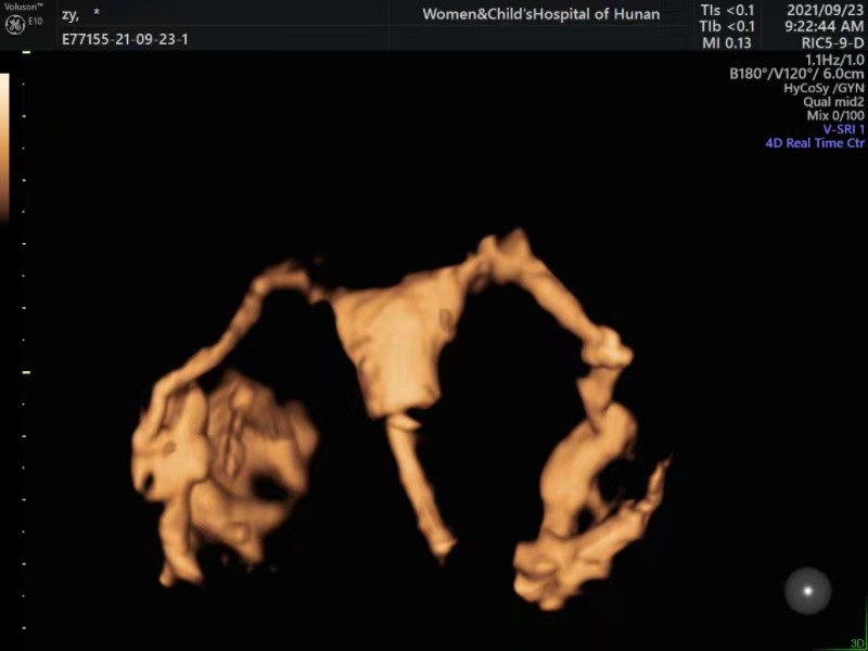 输卵管4d超声造影多久可以要孩子,无痛4d子宫输卵管造影